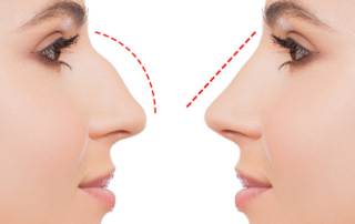 Yüze en uygun burun estetiği