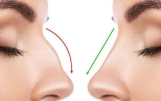 estetik burun ameliyatı