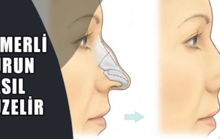 Kemerli Burun Estetiği