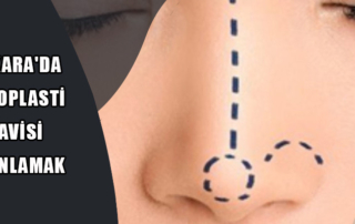 Ankara'da Rinoplasti Tedavisi Planlamak